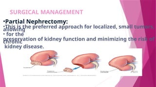 SURGICAL MANAGEMENT
•Partial Nephrectomy:
•This is the preferred approach for localized, small tumors,
allowing
• for the
preservation of kidney function and minimizing the risk of
chronic
kidney disease.
 