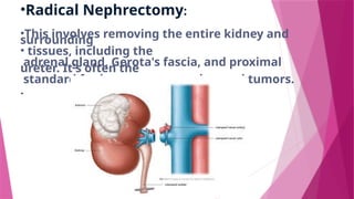 •Radical Nephrectomy:
•This involves removing the entire kidney and
surrounding
• tissues, including the
adrenal gland, Gerota's fascia, and proximal
ureter. It's often the
standard for larger or more advanced tumors.
.
 