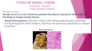TYPES OF RENAL TUMOR
1-BENIGN TUMOR
2-MALIGNANT TUMOR
Benign tumor:
benign tumor is a non-cancerous growth that doesn't spread to other parts of
the body or invade nearby tissues.
-Renal Oncocytoma: A benign tumor in the kidney often found incidentally
during imaging for other reasons, and may not cause any symptoms or require
treatment.
 