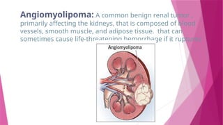 Angiomyolipoma: A common benign renal tumor ,
primarily affecting the kidneys, that is composed of blood
vessels, smooth muscle, and adipose tissue. that can
sometimes cause life-threatening hemorrhage if it ruptures
 
