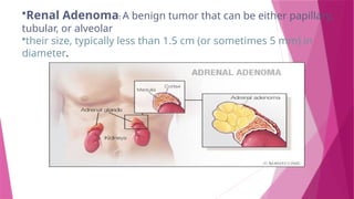 •Renal Adenoma: A benign tumor that can be either papillary,
tubular, or alveolar
•their size, typically less than 1.5 cm (or sometimes 5 mm) in
diameter.
 