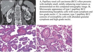 Renal tumors | PPTX