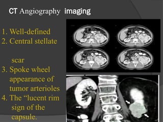 Lucent Rim Sign Renal tumors (2)-1pptx Dr saleh alkuziamah | PPTX