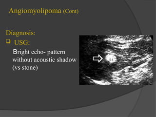 Renal tumors (2)-1pptx Dr saleh alkuziamah | PPTX