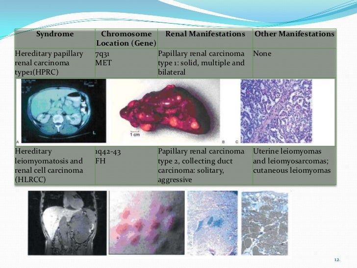 Renal Tumors Renal Cell Carcinoma Dr Vandana
