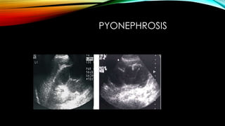 Pyonephrosis Uss Renal pathology in Ultrasound.pdf