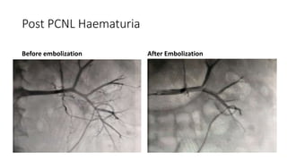 Post PCNL Haematuria
Before embolization After Embolization
 
