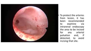 • To protect the arteries
from lesion, it has
been recommended
to examine via
intrarenal endoscopy
the area to be incised
for any arterial
pulsation and, if
detected, to avoid
incising that site.
 