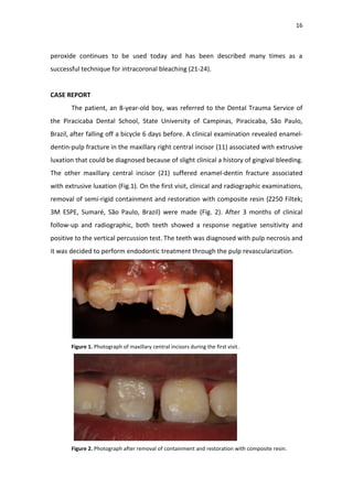 16
peroxide continues to be used today and has been described many times as a
successful technique for intracoronal bleaching (21-24).
CASE REPORT
The patient, an 8-year-old boy, was referred to the Dental Trauma Service of
the Piracicaba Dental School, State University of Campinas, Piracicaba, São Paulo,
Brazil, after falling off a bicycle 6 days before. A clinical examination revealed enamel-
dentin-pulp fracture in the maxillary right central incisor (11) associated with extrusive
luxation that could be diagnosed because of slight clinical a history of gingival bleeding.
The other maxillary central incisor (21) suffered enamel-dentin fracture associated
with extrusive luxation (Fig.1). On the first visit, clinical and radiographic examinations,
removal of semi-rigid containment and restoration with composite resin (Z250 Filtek;
3M ESPE, Sumaré, São Paulo, Brazil) were made (Fig. 2). After 3 months of clinical
follow-up and radiographic, both teeth showed a response negative sensitivity and
positive to the vertical percussion test. The teeth was diagnosed with pulp necrosis and
it was decided to perform endodontic treatment through the pulp revascularization.
Figure 1. Photograph of maxillary central incisors during the first visit.
Figure 2. Photograph after removal of containment and restoration with composite resin.
 