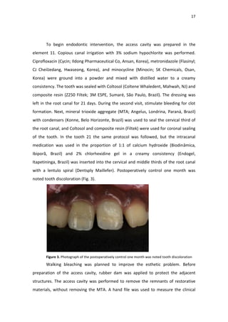 17
To begin endodontic intervention, the access cavity was prepared in the
element 11. Copious canal irrigation with 3% sodium hypochlorite was performed.
Ciprofloxacin (Cycin; Ildong Pharmaceutical Co, Ansan, Korea), metronidazole (Flasinyl;
CJ CheilJedang, Hwaseong, Korea), and minocycline (Minocin; SK Chemicals, Osan,
Korea) were ground into a powder and mixed with distilled water to a creamy
consistency. The tooth was sealed with Coltosol (Coltene Whaledent, Mahwah, NJ) and
composite resin (Z250 Filtek; 3M ESPE, Sumaré, São Paulo, Brazil). The dressing was
left in the root canal for 21 days. During the second visit, stimulate bleeding for clot
formation. Next, mineral trioxide aggregate (MTA; Angelus, Londrina, Paraná, Brazil)
with condensers (Konne, Belo Horizonte, Brazil) was used to seal the cervical third of
the root canal, and Coltosol and composite resin (Filtek) were used for coronal sealing
of the tooth. In the tooth 21 the same protocol was followed, but the intracanal
medication was used in the proportion of 1:1 of calcium hydroxide (Biodinâmica,
Ibiporã, Brazil) and 2% chlorhexidine gel in a creamy consistency (Endogel,
Itapetininga, Brazil) was inserted into the cervical and middle thirds of the root canal
with a lentulo spiral (Dentsply Maillefer). Postoperatively control one month was
noted tooth discoloration (Fig. 3).
Figure 3. Photograph of the postoperatively control one month was noted tooth discoloration
Walking bleaching was planned to improve the esthetic problem. Before
preparation of the access cavity, rubber dam was applied to protect the adjacent
structures. The access cavity was performed to remove the remnants of restorative
materials, without removing the MTA. A hand file was used to measure the clinical
 