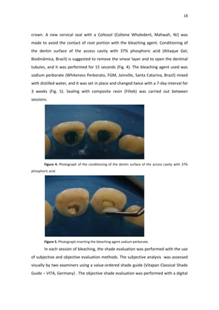 18
crown. A new cervical seal with a Coltosol (Coltene Whaledent, Mahwah, NJ) was
made to avoid the contact of root portion with the bleaching agent. Conditioning of
the dentin surface of the access cavity with 37% phosphoric acid (Attaque Gel,
Biodinâmica, Brazil) is suggested to remove the smear layer and to open the dentinal
tubules, and it was performed for 15 seconds (Fig. 4). The bleaching agent used was
sodium perborate (Whiteness Perborato, FGM, Joinville, Santa Catarina, Brazil) mixed
with distilled water, and it was set in place and changed twice with a 7-day interval for
3 weeks (Fig. 5). Sealing with composite resin (Filtek) was carried out between
sessions.
Figure 4. Photograph of the conditioning of the dentin surface of the access cavity with 37%
phosphoric acid.
Figure 5. Photograph inserting the bleaching agent sodium perborate.
In each session of bleaching, the shade evaluation was performed with the use
of subjective and objective evaluation methods. The subjective analysis was assessed
visually by two examiners using a value-ordered shade guide (Vitapan Classical Shade
Guide – VITA, Germany) . The objective shade evaluation was performed with a digital
 