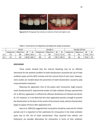 20
Figuras 8 e 9. Photograph that indicate an evidence of teeth with lighter color.
Table 1: Summarize of subjective and objective shade evaluation.
Inicial Sessão 1 Sessão 2/Final
Subjective Objective ∆E ∆L Subjetcive Objective ∆E ∆L Subjetcive Objective ∆E ∆L
11 C3 B4 68.4 66.1 C1 B2 72.4 71.4 B1 A1 74.6 73.7
21 C1 A3 69.8 68.3 B2 A2 70.2 69.2 B1 A1 73.6 73
DISCUSSION
These results showed that the internal bleaching may be an effective
alternative for the aesthetic problem of tooth discoloration caused by the use of triple
antibiotic paste and the MTA inserted until the cervical third of root canal. However,
more studies are needed about the prevention of tooth discoloration caused by pulp
revascularization treatment.
Reducing the application time of the pastes with minocycline might prevent
tooth discoloration(17). Experimental studies of triple antibiotic therapy reported that
24- to 48-hour application is sufficient for effective disinfection of infected root dentin
(9, 17). However, it is not likely that this short application period is enough to prevent
the discoloration on the basis of the results of the present study, wherein discoloration
began to appear 24 hours after application (17).
Sato et al, 1996 (25) suggested that minocycline should be used only for limited
periods and it is important to find substitutes for minocycline in the triple antibiotic
paste due to the risk of tooth discoloration. They reported that cefaclor and
fosfomycin are possible alternatives for minocycline in terms of their antibiotic
 