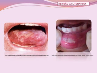 http://medicinaoral.org/blog/wp-content/uploads/2008/04/mucositeradiacao50.jpg   http://www.odontologia.com.br/artigos/imagens/IMG_artigo_odonto_20070110.JPG
 