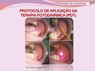 PROTOCOLO DE APLICAÇÃO DA
TERAPIA FOTODINÂMICA (PDT)




   DMC JOURNAL – DEZEMBRO 2010
 