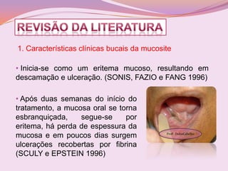 1. Características clínicas bucais da mucosite

• Inicia-se como um eritema mucoso, resultando em
descamação e ulceração. (SONIS, FAZIO e FANG 1996)

• Após duas semanas do início do
tratamento, a mucosa oral se torna
esbranquiçada,    segue-se     por
eritema, há perda de espessura da
mucosa e em poucos dias surgem              Profª. DulceCabelho


ulcerações recobertas por fibrina
(SCULY e EPSTEIN 1996)
 