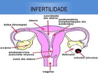 INFERTILIDADE
 