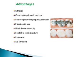 Esthetics
Conservation of tooth structure
Less complex when preparing the tooth
Insulation to pulp
Used almost universally
Bonded to tooth structure
Repairable
No corrosion
 