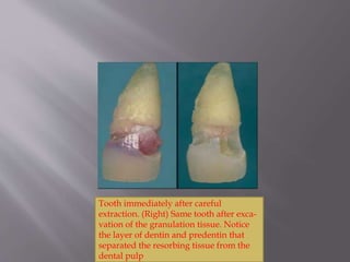 Tooth immediately after careful
extraction. (Right) Same tooth after exca-
vation of the granulation tissue. Notice
the layer of dentin and predentin that
separated the resorbing tissue from the
dental pulp
 