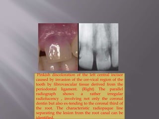 Pinkish discoloration of the left central incisor
caused by invasion of the cer-vical region of the
tooth by fibrovascular tissue derived from the
periodontal ligament. (Right) The parallel
radiograph shows a rather irregular
radiolucency , involving not only the coronal
dentin but also ex-tending to the coronal third of
the root. The characteristic radiopaque line
separating the lesion from the root canal can be
identified.
 
