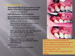 External Approach
 determine the exact location of the
defect (buccal or lingual-palatal)
 Angled radiographs
 full thickness flap is raised
 granulomatous tissue is removed
from the root and the bone defect
 with a curette or bur
 also remove granulomatous tissue
from sound, healthy bone
 so that revascularization of the
resorbing tissues will not occur
 The opening into the root should be
as conservative as possible
 The root defect is filled with a
restorative material
 flap replaced in a way as to
minimize the periodontal defect
after healing
 Indications
 For the small coronal defect
The flap is raised, meaning the
blood supply to the granulomatous
tissue in the root has been cut. B.
The tissue is removed from the root
and bone and C. the
root is filled with a composite resin
filling.
 