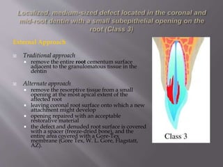 External Approach
 Traditional approach
 remove the entire root cementum surface
adjacent to the granulomatous tissue in the
dentin
 Alternate approach
 remove the resorptive tissue from a small
opening at the most apical extent of the
affected root
 leaving coronal root surface onto which a new
attachment might develop
 opening repaired with an acceptable
restorative material
 the defect and denuded root surface is covered
with a spacer (freeze-dried bone), and the
entire area covered with a Gore-Tex
membrane (Gore Tex, W. L. Gore, Flagstatt,
AZ).
 