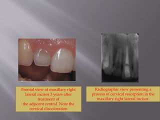 Radiographic view presenting a
process of cervical resorption in the
maxillary right lateral incisor.
Frontal view of maxillary right
lateral incisor 3 years after
treatment of
the adjacent central. Note the
cervical discoloration
 