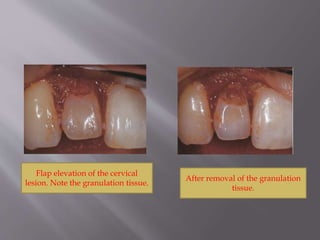 Flap elevation of the cervical
lesion. Note the granulation tissue.
After removal of the granulation
tissue.
 