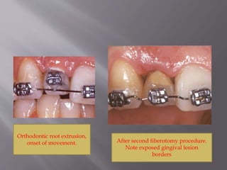 Orthodontic root extrusion,
onset of movement. After second fiberotomy procedure.
Note exposed gingival lesion
borders
 