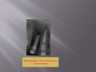 Radiographic view close to end
of movement
 