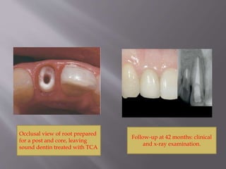 Occlusal view of root prepared
for a post and core, leaving
sound dentin treated with TCA
Follow-up at 42 months: clinical
and x-ray examination.
 