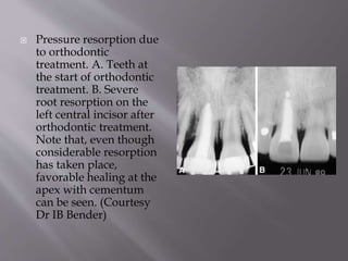  Pressure resorption due
to orthodontic
treatment. A. Teeth at
the start of orthodontic
treatment. B. Severe
root resorption on the
left central incisor after
orthodontic treatment.
Note that, even though
considerable resorption
has taken place,
favorable healing at the
apex with cementum
can be seen. (Courtesy
Dr IB Bender)
 