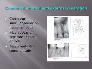  Can occur
simultaneously on
the same tooth
 May appear on
separate or joined
defects
 May eventually
communicate
 