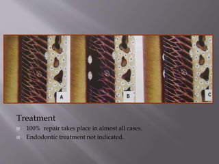  T
Treatment
 100% repair takes place in almost all cases.
 Endodontic treatment not indicated.
 