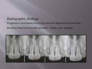 Radiographic findings
Progressive cavitations involving root and adjacent alveolar bone.
Result in total loss of tooth structure within a few months.
 