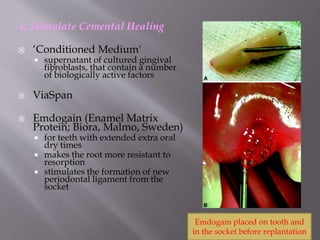 4. Stimulate Cemental Healing
 ‘Conditioned Medium'
 supernatant of cultured gingival
fibroblasts, that contain a number
of biologically active factors
 ViaSpan
 Emdogain (Enamel Matrix
Protein; Biora, Malmo, Sweden)
 for teeth with extended extra oral
dry times
 makes the root more resistant to
resorption
 stimulates the formation of new
periodontal ligament from the
socket
Emdogain placed on tooth and
in the socket before replantation
 