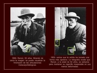 1896- Renoir, 55 años. Mirando de         1903- vemos que la artritis ha tomado una
cerca la imagen, se puede visualizar la    forma más agresiva. La fotografía revela que
    hinchazón de las articulaciones         Renoir, a la edad de 62 años, se esfuerza
          metacarpofalángicas.            para mantener su cigarrillo inseparable en sus
                                                        manos deformadas.
 