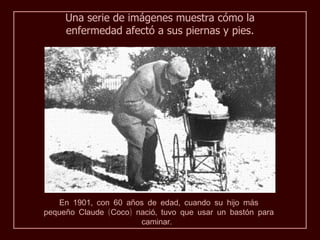 Una serie de imágenes muestra cómo la
     enfermedad afectó a sus piernas y pies.




   En 1901, con 60 años de edad, cuando su hijo más
pequeño Claude (Coco) nació, tuvo que usar un bastón para
                       caminar.
 