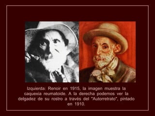 Izquierda: Renoir en 1915, la imagen muestra la
   caquexia reumatoide. A la derecha podemos ver la
delgadez de su rostro a través del "Autorretrato", pintado
                        en 1910.
 