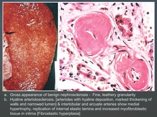 a. Gross appearance of benign nephrosclerosis - Fine, leathery granularity
b. Hyaline arteriolosclerosis. [arterioles with hyaline deposition, marked thickening of
walls and narrowed lumen] & interlobular and arcuate arteries show medial
hypertrophy, replication of internal elastic lamina and increased myofibroblastic
tissue in intima [Fibroelastic hyperplasia]
 