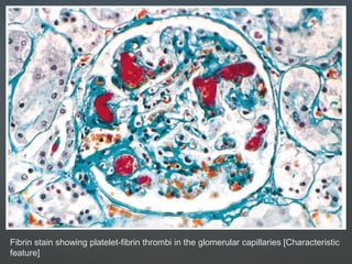 Fibrin stain showing platelet-fibrin thrombi in the glomerular capillaries [Characteristic
feature]
 