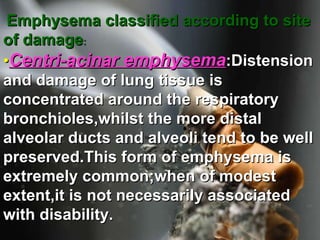Emphysema classified according to site of damage :   • Centri-acinar emphysema :Distension and damage of lung tissue is concentrated around the respiratory bronchioles,whilst the more distal alveolar ducts and alveoli tend to be well preserved.This form of emphysema is extremely common;when of modest extent,it is not necessarily associated with disability.    