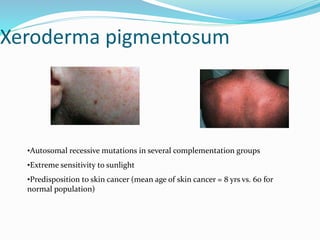Xeroderma pigmentosum
•Autosomal recessive mutations in several complementation groups
•Extreme sensitivity to sunlight
•Predisposition to skin cancer (mean age of skin cancer = 8 yrs vs. 60 for
normal population)
 