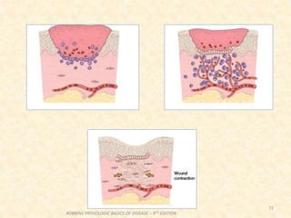 72
ROBBINS PATHOLOGIC BASICS OF DISEASE – 9TH EDITION
 