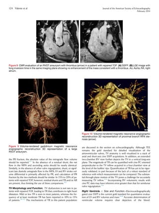 the PR fraction, the absolute value of the retrograde ﬂow volume
should be reported.111
In the absence of a residual shunt, the net
ﬂow in the MPA and ascending aorta should be nearly identical.
Similarly, in the absence of other valve regurgitation, shunt, or signif-
icant late diastolic antegrade ﬂow in the MPA, LV and RV stroke vol-
ume differential is primarily affected by PR, and calculation of PR
fraction by the two methods should be similar. In 15% to 20% of pa-
tients with repaired TOF, however, residual shunts and TR and/or AR
are present, thus limiting the use of these comparisons.112
TV Morphology and Function. TV dysfunction is not rare in pa-
tients with repaired TOF, leading to TR that contributes to right heart
dilatation. Mild or less TR is seen in most patients, whereas the fre-
quency of at least moderate TR has been reported in 10% to 15%
of patients.39,112
The mechanisms of TR in this patient population
are discussed in the section on echocardiography. Although TEE
remains the gold standard for detailed visualization of the
atrioventricular valves, TV anatomy is well visualized in a stack of
axial and short-axis cine SSFP acquisitions. In addition, an extended
two-chamber RV view further depicts the TV in a vertical long-axis
plane. The magnitude of TR can be quantiﬁed with cine PC oriented
perpendicular to the TV inﬂow acquired in a four-chamber view at
the level of the leaﬂets’ tips. Quantiﬁcation of TR has yet to be vigor-
ously validated, in part because of the lack of a robust standard of
reference with which measurements can be compared. The substan-
tial through-plane motion of the TV poses a challenge for accurately
measuring TV inﬂow.113
Incorporating RV volumetric results with
cine PC data may have inherent error greater than that for semilunar
valve regurgitation.114
Right Ventricle. i. Size and Function.–Electrocardiographically
gated cine SSFP is the current gold standard for quantitative evalua-
tion of LV and RV volumes and mass.9,10
Accurate determination of
ventricular volume requires clear depiction of the blood-
Figure 8 CMR evaluation of an RVOT aneurysm with thrombus (arrow) in a patient with repaired TOF. (A) SSFP. (B) LGE image with
long inversion time in the same imaging plane showing no enhancement of the mass consistent with a thrombus. Ao, Aorta; RA, right
atrium.
Figure 10 Volume-rendered magnetic resonance angiographic
reconstruction 3D representation of proximal branch RPA ste-
nosis (arrow).
Figure 9 Volume-rendered gadolinium magnetic resonance
angiographic reconstruction 3D representation of a large
RVOT aneurysm.
124 Valente et al Journal of the American Society of Echocardiography
February 2014
 