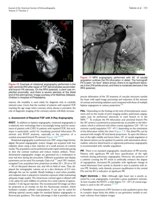 reasons, the modality is used solely for diagnosis only in carefully
selected cases. Given that the number of patients with repaired TOF
reaching the age range when coronary artery disease is prevalent, the
role of diagnostic imaging of the coronary arteries will likely increase.
c. Assessment of Repaired TOF with X-Ray Angiography
RVOT. In addition to biplane angiography, rotational angiography is
a relatively new technology that is increasingly being used for assess-
ment of patients with CHD. In patients with repaired TOF, this tech-
nique is particularly useful for visualizing proximal bifurcation PA
stenosis and RVOT anatomy, especially in the presence of a
conduit-associated branch PA stenosis (Figure 16).184,185
Rotational angiography is performed over 200
using a large-format,
digital, ﬂat-panel angiographic system. Images are acquired with low
radiation doses using a slow injection of a small amount of contrast
media. Theacquisitioncanbe performedunder rapid ventricularpacing
to slow the contrast washout and reduce motion artifacts. Three-
dimensional angiographic images are generated on a workstation in
near real time during the procedure. Different acquisition and display
parameters can be used. For example, Glatz et al.185
used 190
rotation,
nongated 5-sec acquisition time, projection on either 20 Â 20 cm or 30
Â 40 cm ﬂat-panel detector size, and 48-cm ﬁeld of view. They dis-
played the tomographic volume set at a slice thickness of 0.3 mm,
although this can be variable. Breath holding is used when possible,
and radiation dose is adjusted to minimize exposure while maintaining
adequate image quality. The intravenous contrast agent is diluted with
2 mL saline for each milliliter of contrast, for a total volume of approx-
imately 1.5 mL/kg per injection. The reconstructed 3D image can then
be projected as an overlay on the live ﬂuoroscopy monitor, which
facilitates complex catheter manipulations. It can also be useful for
deﬁning optimal camera angles for standard biplane angiography or
ﬂuoroscopic guidance. The main advantage is that it provides a more
precise delineation of the 3D anatomy of vascular structures outside
the heart with rapid image processing and reduction of the amount
of contrast and ionizing radiation used compared with those of multiple
biplane angiograms in various projections.186
PAs. Depending on the ﬁndings at the time of hemodynamic assess-
ment and on the results of prior imaging studies, pulmonary angiog-
raphy may be performed selectively in each branch or in the
MPA.187
To evaluate the PA bifurcation and proximal branch PAs
the AP camera is positioned as perpendicular as possible to the bifur-
cation, which is achieved with either cranial angulation (20
–30
) or
extreme caudal angulation (35
–45
), depending on the orientation
of the bifurcation within the chest (Figure 17). The distal PAs can be
assessed with straight AP and lateral projections. To open the bifurca-
tion of the right middle and lower lobes, 20
of caudal angulation in
the lateral camera can be applied. In patients with arborization abnor-
malities, selective distal branch or segmental pulmonary angiography
is recommended with variable angulation.
PR. There is no standard angiographic classiﬁcation of PR severity.
Patients with signiﬁcant PR will have opaciﬁcation of the right
ventricle during pulmonary angiography. However, the presence of
a catheter crossing the PV tends to artiﬁcially enhance the degree
of regurgitation. Increased PA pulsatility with signiﬁcant change in
vessel dimension from systole to diastole is seen in patients with se-
vere PR. Similarly, early diastolic pressure equilibration in the central
PAs and the RV is indicative of signiﬁcant PR.
Right Ventricle. i. Size.–Although right heart size is poorly as-
sessed by x-ray angiography, it provides a gross qualitative estimate.
To best visualize the RVOT, a mild degree (15
–20
) of cranial angu-
lation is used in the AP camera.187,188
ii. Function.–Assessment of RV function is only qualitative given that
its complex shape limits the ability to use geometric models to esti-
mate volumes from biplane images.
Figure 16 Example of rotational angiography performed in the
right ventricle (RV) after repair of TOF demonstrates severe bilat-
eral branch PA stenosis. On the RPA (asterisk), a stent was im-
planted proximally, and there is severe stenosis at the distal
end of the stent (arrow). Image courtesy of Dr Matthew Gillespie,
Children’s Hospital of Philadelphia.
Figure 17 MPA angiography performed with 40
of caudal
angulation outlines the PA bifurcation in detail. The homograft
PV is seen ‘‘en face’’ (black arrow), there is no signiﬁcant steno-
sis in the LPA (white arrow), and there is moderate stenosis in the
RPA (asterisk).
Journal of the American Society of Echocardiography
Volume 27 Number 2
Valente et al 133
 