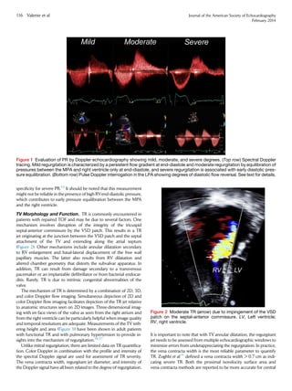 speciﬁcity for severe PR.35
It should be noted that this measurement
might not be reliable in the presence of high RVend-diastolic pressure,
which contributes to early pressure equilibration between the MPA
and the right ventricle.
TV Morphology and Function. TR is commonly encountered in
patients with repaired TOF and may be due to several factors. One
mechanism involves disruption of the integrity of the tricuspid
septal-anterior commissure by the VSD patch. This results in a TR
jet originating at the junction between the VSD patch and the septal
attachment of the TV and extending along the atrial septum
(Figure 2). Other mechanisms include annular dilatation secondary
to RV enlargement and basal-lateral displacement of the free wall
papillary muscles. The latter also results from RV dilatation and
altered chamber geometry that distorts the subvalvar apparatus. In
addition, TR can result from damage secondary to a transvenous
pacemaker or an implantable deﬁbrillator or from bacterial endocar-
ditis. Rarely, TR is due to intrinsic congenital abnormalities of the
valve.
The mechanism of TR is determined by a combination of 2D, 3D,
and color Doppler ﬂow imaging. Simultaneous depiction of 2D and
color Doppler ﬂow imaging facilitates depiction of the TR jet relative
to anatomic structures seen on 2D images. Three-dimensional imag-
ing with en face views of the valve as seen from the right atrium and
from the right ventricle can be particularly helpful when image quality
and temporal resolutions are adequate. Measurements of the TV teth-
ering height and area (Figure 3) have been shown in adult patients
with functional TR and with pulmonary hypertension to provide in-
sights into the mechanism of regurgitation.36,37
Unlike mitral regurgitation, there are limited data on TR quantiﬁca-
tion. Color Doppler in combination with the proﬁle and intensity of
the spectral Doppler signal are used for assessment of TR severity.
The vena contracta width, regurgitant jet diameter, and intensity of
the Doppler signal have all been related to the degree of regurgitation.
It is important to note that with TV annular dilatation, the regurgitant
jet needs to be assessed from multiple echocardiographic windows to
minimize errors from underappreciating the regurgitation. In practice,
the vena contracta width is the most reliable parameter to quantify
TR. Zoghbi et al.31
deﬁned a vena contracta width  0.7 cm as indi-
cating severe TR. Both the proximal isovelocity surface area and
vena contracta methods are reported to be more accurate for central
Figure 1 Evaluation of PR by Doppler echocardiography showing mild, moderate, and severe degrees. (Top row) Spectral Doppler
tracing. Mild regurgitation is characterized by a persistent ﬂow gradient at end-diastole and moderate regurgitation by equilibration of
pressures between the MPA and right ventricle only at end-diastole, and severe regurgitation is associated with early diastolic pres-
sure equilibration. (Bottom row) Pulse Doppler interrogation in the LPA showing degrees of diastolic ﬂow reversal. See text for details.
Figure 2 Moderate TR (arrow) due to impingement of the VSD
patch on the septal-anterior commissure. LV, Left ventricle;
RV, right ventricle.
116 Valente et al Journal of the American Society of Echocardiography
February 2014
 