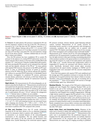 iii. Pressure.–In adult patients, RA pressure is estimated by RA size
and the respiratory variation in the size of the IVC. RA pressure is
assumed to be 3 mm Hg when the IVC diameter measures # 2.1
cm with 50% collapse, whereas with an IVC  2.1 cm and 50%
collapse, a high RA pressure of 15 mm Hg is assumed. An intermedi-
ate value of 8 mm Hg is used when IVC size and respiratory change
do not ﬁt the above scheme.23
Similarly validated data are not avail-
able in infants and children.
Once the RA pressure has been established, RV or systolic PA
pressure (in the absence of a residual RVOTobstruction) can be esti-
mated using the TR jet velocity on the basis of the modiﬁed Bernoulli
equation: 4v2
+ RA pressure. Using the modiﬁed Bernoulli equation,
the mean and diastolic PA pressures can be estimated from the peak
early and late diastolic velocities of the PR jet.23
In many patients
with repaired TOF, however, the pressure in the MPA and RVequil-
ibrates in early or mid-diastole because of partial or complete
absence of the PV. When the TR jet velocity indicates RV hyperten-
sion without an associated RVOT obstruction or identiﬁable branch
PA stenosis, investigation for peripheral PA stenosis, pulmonary
vascular disease, pulmonary vein stenosis, or left heart disease (e.g.,
cor triatriatum, mitral stenosis, diastolic LV dysfunction) should be
carried out.
Right Atrium. RA measurements by 2D echocardiography are ob-
tained as described by Rudski et al.23
Measurements are performed at
end-systole from the apical four-chamber view with the major axis ob-
tained from the middle of the bisected TV annulus to the posterior
wall of the right atrium and the minor axis taken at 90
to the major
axis. In adult patients, RA area  18 cm2
indicates RA enlargement
(Table 3). Normal values in children are not available.
In a study that compared RA size and function between 50 patients
with repaired TOF and 30 normal controls, Hui et al.79
found that RA
size was increased (mean apical four-chamber area, 16.8 6 5.5 vs 13.7
6 5.1 cm2
; P = .013) and emptying function was decreased (mean
active emptying area fraction, 19 6 9.8% vs 26.3 6 10.3%, P =
.005) after TOF repair. Similarly, RA systolic and diastolic strain values
were lower in patients with TOF compared with controls.
LV Size and Function. Given that LV systolic dysfunction
measured by EF has been shown to be an important prognostic
marker for premature death in patients with repaired TOF,50,80,81
its assessment is an essential element of the echocardiographic
examination in this population. The size, global function, and
regional wall motion of the left ventricle are determined from
multiple views. Systolic ﬂattening of the ventricular septum suggests
RV pressure overload, whereas diastolic septal ﬂattening indicates
volume overload. Measurement of LV systolic function by
shortening fraction assumes a circular geometry with homogenous
contraction, conditions that are seldom met in patients with
repaired TOF. The biplane area-length method may be less suscepti-
ble to these assumptions and is preferred when technically feasible.82
Measurements of LV volumes and EF by 3D echocardiography are
preferred over 2D measurements. In patients with marked RV dilata-
tion, the right ventricle is often apex forming, necessitating adjustment
of the transducer position in the apical windows to avoid foreshorten-
ing of the left ventricle. In a study of 413 adult patients with repaired
TOF, Diller et al.83
recently showed that nongeometric indices of
longitudinal LV function are associated with adverse clinical out-
comes. Speciﬁcally, decreased mitral annular plane excursion
measured from the apical window (analogous to TAPSE) and LV
longitudinal strain were associated with the outcome independent
of QRS duration.
Given that most patients with repaired TOF reach adulthood and
the average age of this population continues to increase, the risk for
development of acquired ischemic heart disease is likely to increase.
Therefore, stress echocardiography may play an increasing role in
this population.84,85
Stress can be induced with exercise or through
a pharmacologic agent (e.g., dobutamine).
Residual Shunts. The integrity of the VSD patch is determined by
imaging and color Doppler ﬂow mapping. Residual VSDs can be
located at any part of the ventricular septum but are particularly
common at the superior portion of the patch. These can usually be
visualized by color Doppler from multiple imaging planes. Although
a high-velocity systolic jet suggests that RV pressure is low, it should
not be used independently to measure RV pressure, as the size of
the VSD may vary during the cardiac cycle, and the jet may be eccen-
tric. Similarly, the atrial septum is examined by color Doppler for the
presence of a patent foramen ovale or a secundum atrial septal defect.
Rarely, unrepaired sinus venosus defect, coronary sinus septal defect,
or partially anomalous pulmonary venous connections are detected
late after TOF repair.
Aortic Valve, Root, and Ascending Aorta. Dilatation of the
aortic root is common in adults with repaired TOF, particularly those
with prior shunts and those with late repair.86,87
Measurements of the
aortic root is accomplished from the parasternal long-axis view.
Imaging from the right parasternal window can facilitate depiction
and measurements of the proximal and mid ascending aorta.
Measurements are made using 2D imaging according to published
Figure 6 Tissue Doppler of (A) normal (peak S0
velocity, 14 cm/sec) and (B) depressed (peak S0
velocity, 7 cm/sec) RV systolic
function.
Journal of the American Society of Echocardiography
Volume 27 Number 2
Valente et al 119
 