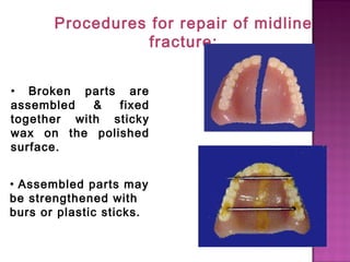 Procedures for repair of midline
fracture:
• Broken parts are
assembled
&
fixed
together with sticky
wax on the polished
surface.
• Assembled parts may
be strengthened with
burs or plastic sticks.

 