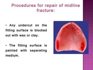 Procedures for repair of midline
fracture:
• Any undercut on the
fitting surface is blocked
out with wax or clay.
• The fitting surface is
painted
medium.

with

separating

 