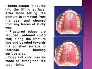 • Stone plaster is poured
into the fitting surface.
After stone setting, the
denture is removed from
the cast and cleaned
from any traces of sticky
wax.
• Fractured edges are
reduced, widened (8-10
mm) along the fracture
line and beveled towards
the polished surface to
increase
bonding
surface area.
• Dove tail cuts may be
made to strengthen the
repair joint.

 